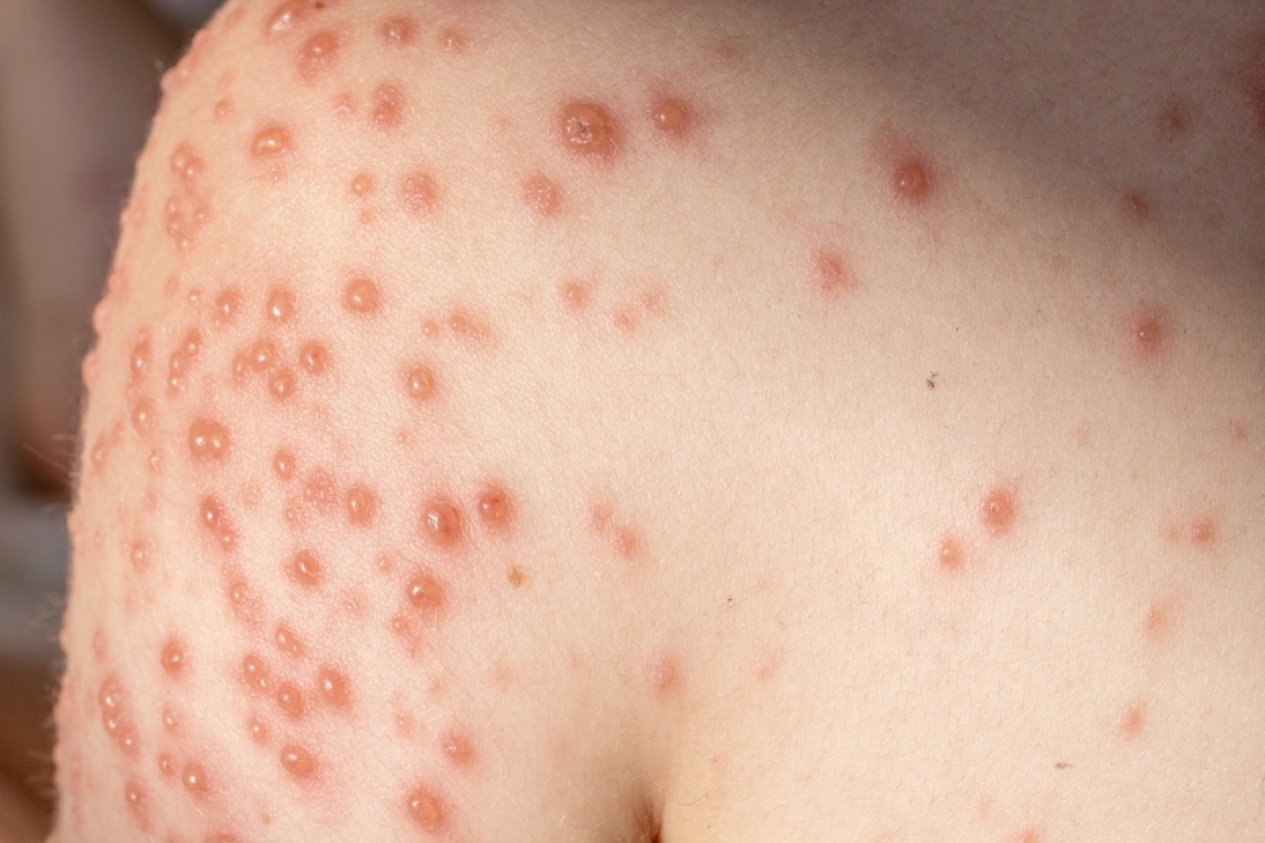 Oslabljen imunski sistem po prebolelih noricah: kaj morajo starši vedeti