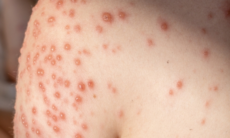 Oslabljen imunski sistem po prebolelih noricah: kaj morajo starši vedeti