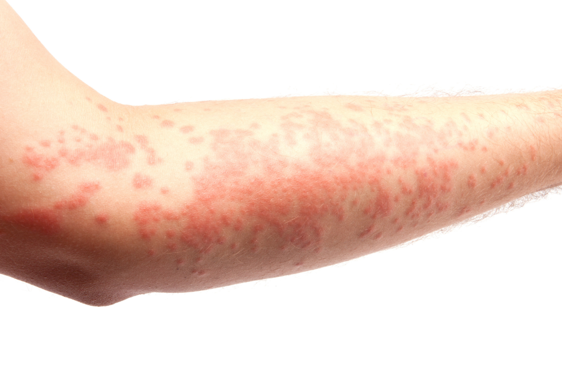 Ob dnevu melanoma opozorila o zaščiti pred soncem